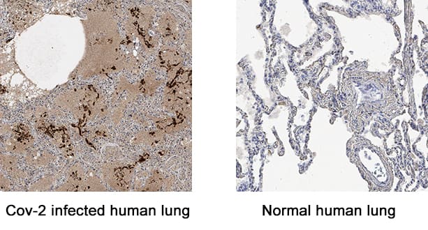 SARS-CoV-2 Nucleocapsid was detected in immersion fixed paraffin-embedded sections of SARS-CoV-2 infected human lung (left, positive staining) and normal human lung (right, negative control) using Mouse Anti-SARS-CoV-2 Nucleocapsid Monoclonal Antibody (Catalog # MAB10474) at 5 µg/mL for 1 hour at room temperature followed by incubation with the Anti-Mouse IgG VisUCyte™ HRP Polymer Antibody (VC001). Before incubation with the primary antibody, tissue was subjected to heat-induced epitope retrieval using Antigen Retrieval Reagent-Basic (CTS013). Tissue was stained using DAB (brown) and counterstained with hematoxylin (blue). Specific staining was localized to SARS-CoV-2 infected cells. Staining was performed using our protocol for IHC Staining with VisUCyte HRP Polymer Detection Reagents.