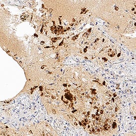 SARS-CoV-2 Membrane Protein was detected in immersion fixed paraffin-embedded sections of SARS-CoV-2 infected human lung using Mouse Anti-SARS-CoV-2 Membrane Monoclonal Antibody (Catalog # MAB10690) at 3 µg/mL for 1 hour at room temperature followed by incubation with the Anti-Mouse IgG VisUCyte™ HRP Polymer Antibody (VC001). Before incubation with the primary antibody, tissue was subjected to heat-induced epitope retrieval using Antigen Retrieval Reagent-Basic (CTS013). Tissue was stained using DAB (brown) and counterstained with hematoxylin (blue). Specific staining was localized to immunoreactive profiles scattered throughout the tissue. Staining was performed using our protocol for IHC Staining with VisUCyte HRP Polymer Detection Reagents.