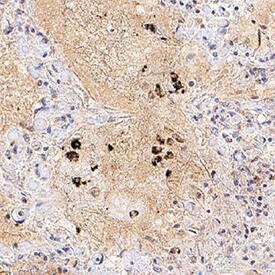 ORF8 was detected in immersion fixed paraffin-embedded sections of SARS-CoV-2 infected human lung using Mouse Anti-SARS-CoV-2 ORF8 Monoclonal Antibody (Catalog # MAB10820) at 5 &micro;g/mL for 1 hour at room temperature followed by incubation with the Anti-Mouse IgG VisUCyte&trade; HRP Polymer Antibody (VC001). Before incubation with the primary antibody, tissue was subjected to heat-induced epitope retrieval using Antigen Retrieval Reagent-Basic (CTS013). Tissue was stained using DAB (brown) and counterstained with hematoxylin (blue). Specific staining was localized to immunoreactive profiles scattered throughout the tissue. Staining was performed using our protocol for IHC Staining with VisUCyte HRP Polymer Detection Reagents.