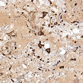 Spike RBD was detected in immersion fixed paraffin-embedded sections of SARS-CoV-2 infected human lung using Rabbit Anti-SARS-CoV-2 Spike RBD Monoclonal Antibody (Catalog # MAB10890) at 3 µg/mL for 1 hour at room temperature followed by incubation with the Anti-Rabbit IgG VisUCyte™ HRP Polymer Antibody (Catalog # VC003). Before incubation with the primary antibody, tissue was subjected to heat-induced epitope retrieval using Antigen Retrieval Reagent-Basic (Catalog # CTS013). Tissue was stained using DAB (brown) and counterstained with hematoxylin (blue). Specific staining was localized to immunoreactive profiles scattered throughout the tissue. View our protocol for IHC Staining with VisUCyte HRP Polymer Detection Reagents.