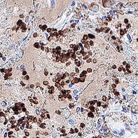 NSP1 was detected in immersion fixed paraffin-embedded sections of SARS-CoV-2 infected human lung using Mouse Anti-SARS-CoV-2 NSP1 Monoclonal Antibody (Catalog # MAB10980) at 5 µg/mL for 1 hour at room temperature followed by incubation with the Anti-Mouse IgG VisUCyte™ HRP Polymer Antibody (Catalog # VC001). Before incubation with the primary antibody, tissue was subjected to heat-induced epitope retrieval using Antigen Retrieval Reagent-Basic (Catalog # CTS013). Tissue was stained using DAB (brown) and counterstained with hematoxylin (blue). Specific staining was localized to immunoreactive profiles scattered throughout the tissue. View our protocol for IHC Staining with VisUCyte HRP Polymer Detection Reagents.