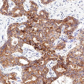 FGF basic/FGF2/bFGF was detected in immersion fixed paraffin-embedded sections of Human Liver Cancer using Mouse Anti-Human FGF basic/FGF2/bFGF Monoclonal Antibody (Catalog # MAB11377) at 5 µg/mL for 1 hour at room temperature followed by incubation with the Anti-Mouse IgG VisUCyte™ HRP Polymer Antibody (Catalog # VC001). Before incubation with the primary antibody, tissue was subjected to heat-induced epitope retrieval using VisUCyte Antigen Retrieval Reagent-Basic (Catalog # VCTS021). Tissue was stained using DAB (brown) and counterstained with hematoxylin (blue). Specific staining was localized to cytoplasm in hepatocytes. View our protocol for IHC Staining with VisUCyte HRP Polymer Detection Reagents.