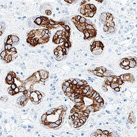 Cytokeratin 17/19 was detected in immersion fixed paraffin-embedded sections of human squamous cell carcinoma using Mouse Anti-Human Cytokeratin 17/19 Monoclonal Antibody (Catalog # MAB11568) at 5 µg/ml for 1 hour at room temperature followed by incubation with the Anti-Mouse IgG VisUCyte&trade; HRP Polymer Antibody (Catalog # VC001) or the HRP-conjugated Anti-Mouse IgG Secondary Antibody (Catalog # HAF007). Before incubation with the primary antibody, tissue was subjected to heat-induced epitope retrieval using VisUCyte Antigen Retrieval Reagent-Basic (Catalog # VCTS021). Tissue was stained using DAB (brown) and counterstained with hematoxylin (blue). Specific staining was localized to the membrane. View our protocol for Chromogenic IHC Staining of Paraffin-embedded Tissue Sections.