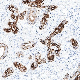 Cytokeratin 17 was detected in immersion fixed paraffin-embedded sections of human squamous cell carcinoma using Mouse Anti-Human Cytokeratin 17 Monoclonal Antibody (Catalog # MAB11571) at 5 µg/ml for 1 hour at room temperature followed by incubation with the Anti-Mouse IgG VisUCyte™ HRP Polymer Antibody (Catalog # VC001) or the HRP-conjugated Anti-Mouse IgG Secondary Antibody (Catalog # HAF007). Before incubation with the primary antibody, tissue was subjected to heat-induced epitope retrieval using VisUCyte Antigen Retrieval Reagent-Basic (Catalog # VCTS021). Tissue was stained using DAB (brown) and counterstained with hematoxylin (blue). Specific staining was localized to the cytoplasm. View our protocol for Chromogenic IHC Staining of Paraffin-embedded Tissue Sections.