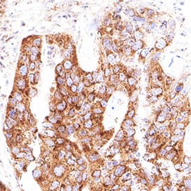 CS Citrate Synthase was detected in immersion fixed paraffin-embedded sections of human liver cancer using Mouse Anti-Human CS Citrate Synthase Monoclonal Antibody (Catalog # MAB11583) at 5 µg/ml for 1 hour at room temperature followed by incubation with the Anti-Mouse IgG VisUCyte™ HRP Polymer Antibody (Catalog # VC001). Before incubation with the primary antibody, tissue was subjected to heat-induced epitope retrieval using VisUCyte Antigen Retrieval Reagent-Basic (Catalog # VCTS021). Tissue was stained using DAB (brown) and counterstained with hematoxylin (blue). Specific staining was localized to the cytoplasm. View our protocol for IHC Staining with VisUCyte HRP Polymer Detection Reagents.