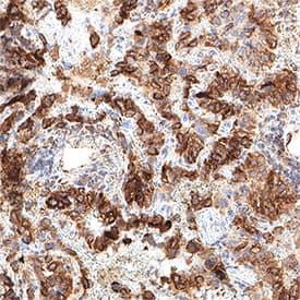 Glut1 was detected in immersion fixed paraffin-embedded sections of human lung cancer using Mouse Anti-Human Glut1 Monoclonal Antibody (Catalog # MAB11601) at 5 µg/ml for 1 hour at room temperature followed by incubation with the Anti-Mouse IgG VisUCyte™ HRP Polymer Antibody (Catalog # VC001). Before incubation with the primary antibody, tissue was subjected to heat-induced epitope retrieval using VisUCyte Antigen Retrieval Reagent-Basic (Catalog # VCTS021). Tissue was stained using DAB (brown) and counterstained with hematoxylin (blue). Specific staining was localized to the cell membrane. View our protocol for IHC Staining with VisUCyte HRP Polymer Detection Reagents.