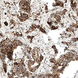 Glut1 was detected in immersion fixed paraffin-embedded sections of human pancreatic cancer using Mouse Anti-Human Glut1 Monoclonal Antibody (Catalog # MAB11601) at 5 µg/ml for 1 hour at room temperature followed by incubation with the Anti-Mouse IgG VisUCyte™ HRP Polymer Antibody (Catalog # VC001). Before incubation with the primary antibody, tissue was subjected to heat-induced epitope retrieval using VisUCyte Antigen Retrieval Reagent-Basic (Catalog # VCTS021). Tissue was stained using DAB (brown) and counterstained with hematoxylin (blue). Specific staining was localized to the cell membrane. View our protocol for IHC Staining with VisUCyte HRP Polymer Detection Reagents.