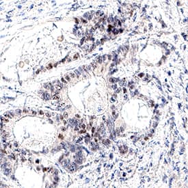 Exosome Component 9 was detected in immersion fixed paraffin-embedded sections of human colon cancer using Mouse Anti-Human Exosome Component 9 Monoclonal Antibody (Catalog # MAB11616) at 5 µg/ml for 1 hour at room temperature followed by incubation with the Anti-Mouse IgG VisUCyte™ HRP Polymer Antibody (Catalog # VC001). Before incubation with the primary antibody, tissue was subjected to heat-induced epitope retrieval using VisUCyte Antigen Retrieval Reagent-Basic (Catalog # VCTS021). Tissue was stained using DAB (brown) and counterstained with hematoxylin (blue). Specific staining was localized to the nucleus. View our protocol for IHC Staining with VisUCyte HRP Polymer Detection Reagents.