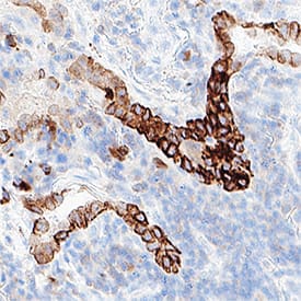 Cytokeratin 7 was detected in immersion fixed paraffin-embedded sections of human lung cancer using Mouse Anti-Human Cytokeratin 7 Monoclonal Antibody (Catalog # MAB11626) at 5 µg/ml for 1 hour at room temperature followed by incubation with the Anti-Mouse IgG VisUCyte™ HRP Polymer Antibody (Catalog # VC001). Before incubation with the primary antibody, tissue was subjected to heat-induced epitope retrieval using VisUCyte Antigen Retrieval Reagent-Basic (Catalog # VCTS021). Tissue was stained using DAB (brown) and counterstained with hematoxylin (blue). Specific staining was localized to the cytoplasm. View our protocol for IHC Staining with VisUCyte HRP Polymer Detection Reagents.
