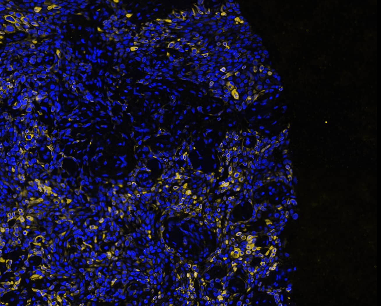 Cytokeratin 7 Peptide was detected in immersion fixed paraffin-embedded sections of human Pancreas Tumor using Mouse Anti-Human KRT7, Monoclonal Antibody (Catalog #MAB11626) at 25ug/mL at 37 ° Celsius for 4 minutes. Before incubation with the primary antibody, tissue underwent an all-in-one dewaxing and antigen retrieval preprocessing using PreTreatment Module (PT Module) and Dewax and HIER Buffer H (pH 9; Epredia Catalog # TA-999-DHBH). Tissue was stained using the Alexa Fluor™ 647 Goat anti-Mouse IgG Secondary Antibody at 1:200 at 37 ° Celsius for 2 minutes. (Yellow; Lunaphore Catalog # DR647MS) and counterstained with DAPI (blue; Lunaphore Catalog # DR100). Specific staining was localized to the cytoplasm. Protocol available in COMET™ Panel Builder.