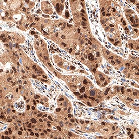 Cdk6 was detected in immersion fixed paraffin-embedded sections of human lung cancer using Mouse Anti-Human Cdk6 Monoclonal Antibody (Catalog # MAB11636) at 5 µg/ml for 1 hour at room temperature followed by incubation with the Anti-Mouse IgG VisUCyte™ HRP Polymer Antibody (Catalog # VC001). Before incubation with the primary antibody, tissue was subjected to heat-induced epitope retrieval using VisUCyte Antigen Retrieval Reagent-Basic (Catalog # VCTS021). Tissue was stained using DAB (brown) and counterstained with hematoxylin (blue). Specific staining was localized to the nucleus and cytoplasm. View our protocol for IHC Staining with VisUCyte HRP Polymer Detection Reagents.