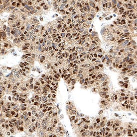 Cdk6 was detected in immersion fixed paraffin-embedded sections of human pancreatic cancer using Mouse Anti-Human Cdk6 Monoclonal Antibody (Catalog # MAB11636) at 5 µg/ml for 1 hour at room temperature followed by incubation with the Anti-Mouse IgG VisUCyte™ HRP Polymer Antibody (Catalog # VC001). Before incubation with the primary antibody, tissue was subjected to heat-induced epitope retrieval using VisUCyte Antigen Retrieval Reagent-Basic (Catalog # VCTS021). Tissue was stained using DAB (brown) and counterstained with hematoxylin (blue). Specific staining was localized to the nucleus and cytoplasm. View our protocol for IHC Staining with VisUCyte HRP Polymer Detection Reagents.