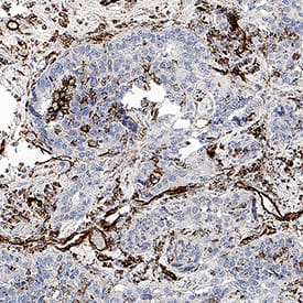CD31/PECAM‑1 was detected in immersion fixed paraffin-embedded sections of human liver tumor using Mouse Anti-Human CD31/PECAM‑1 Monoclonal Antibody (Catalog # MAB11666) at 0.05 µg/ml for 1 hour at room temperature followed by incubation with the Anti-Mouse IgG VisUCyte™ HRP Polymer Antibody (Catalog # VC001) or the HRP-conjugated Anti-Mouse IgG Secondary Antibody (Catalog # HAF007). Before incubation with the primary antibody, tissue was subjected to heat-induced epitope retrieval using VisUCyte Antigen Retrieval Reagent-Basic (Catalog # VCTS021). Tissue was stained using DAB (brown) and counterstained with hematoxylin (blue). Specific staining was localized to the cell surface. View our protocol for IHC Staining with VisUCyte HRP Polymer Detection Reagents.