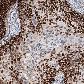 MCM4 was detected in immersion fixed paraffin-embedded sections of human cervical cancer using Mouse Anti-Human MCM4 Monoclonal Antibody (Catalog # MAB11718) at 5 µg/ml for 1 hour at room temperature followed by incubation with the Anti-Mouse IgG VisUCyte&trade; HRP Polymer Antibody (Catalog # VC001) or the HRP-conjugated Anti-Mouse IgG Secondary Antibody (Catalog # HAF007). Before incubation with the primary antibody, tissue was subjected to heat-induced epitope retrieval using VisUCyte Antigen Retrieval Reagent-Basic (Catalog # VCTS021). Tissue was stained using DAB (brown) and counterstained with hematoxylin (blue). Specific staining was localized to the nucleus. View our protocol for Chromogenic IHC Staining of Paraffin-embedded Tissue Sections.