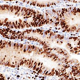 MCM4 was detected in immersion fixed paraffin-embedded sections of human colon cancer using Mouse Anti-Human MCM4 Monoclonal Antibody (Catalog # MAB11718) at 5 µg/ml for 1 hour at room temperature followed by incubation with the Anti-Mouse IgG VisUCyte&trade; HRP Polymer Antibody (Catalog # VC001) or the HRP-conjugated Anti-Mouse IgG Secondary Antibody (Catalog # HAF007). Before incubation with the primary antibody, tissue was subjected to heat-induced epitope retrieval using VisUCyte Antigen Retrieval Reagent-Basic (Catalog # VCTS021). Tissue was stained using DAB (brown) and counterstained with hematoxylin (blue). Specific staining was localized to the nucleus. View our protocol for Chromogenic IHC Staining of Paraffin-embedded Tissue Sections.