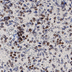 SOX11 was detected in immersion fixed paraffin-embedded sections of human glioblastoma using Mouse Anti-Human SOX11 Monoclonal Antibody (Catalog # MAB11734) at 5 µg/ml for 1 hour at room temperature followed by incubation with the HRP-conjugated Anti-Mouse IgG Secondary Antibody (Catalog # HAF007). Before incubation with the primary antibody, tissue was subjected to heat-induced epitope retrieval using VisUCyte Antigen Retrieval Reagent-Basic (Catalog # VCTS021). Tissue was stained using DAB (brown) and counterstained with hematoxylin (blue). Specific staining was localized to the nucleus. View our protocol for IHC Staining with VisUCyte HRP Polymer Detection Reagents.