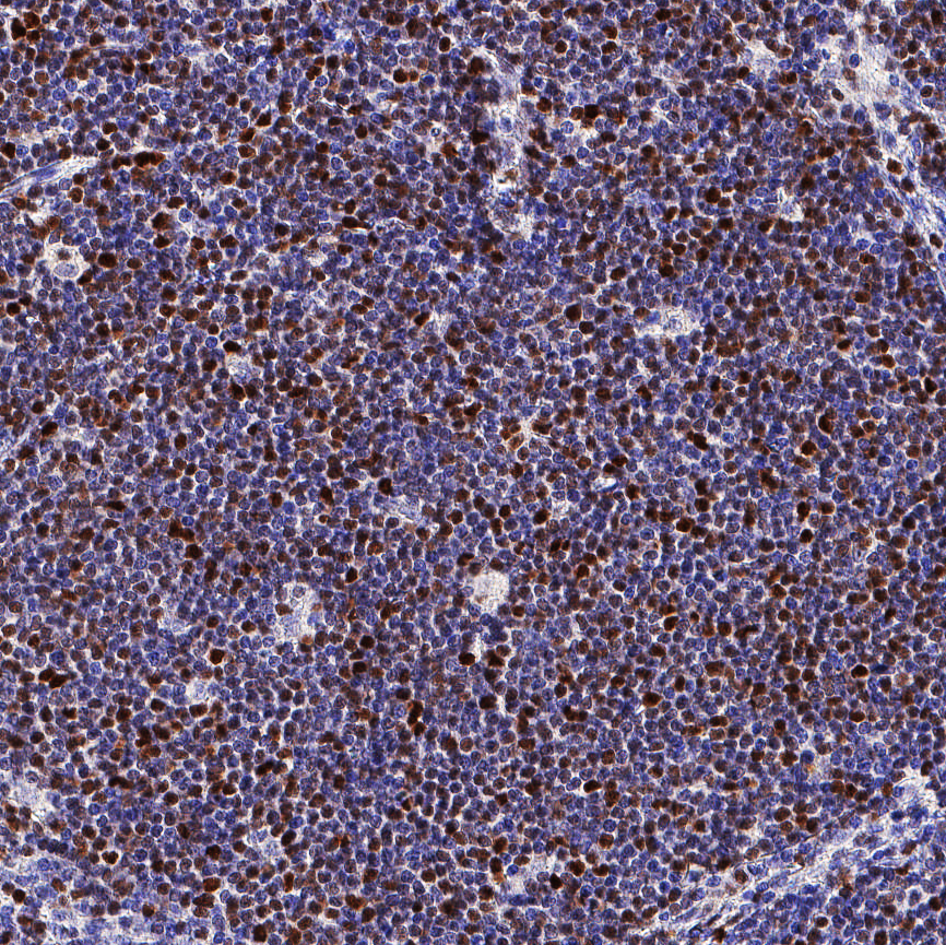 SOX11 was detected in immersion fixed paraffin-embedded sections of human mantle cell lymphoma using Mouse Anti-Human SOX11 Monoclonal Antibody (Catalog # MAB11734) at 15 µg/ml overnight at 4 &deg;C. Before incubation with the primary antibody, tissue was subjected to heat-induced epitope retrieval using VisUCyte Antigen Retrieval Reagent-Basic (Catalog # VCTS021). Tissue was stained using the HRP-conjugated Anti-Mouse IgG Secondary Antibody (Catalog # HAF007) and counterstained with hematoxylin (blue). Specific staining was localized to the nucleus. View our protocol for Chromogenic IHC Staining of Paraffin-embedded Tissue Sections.