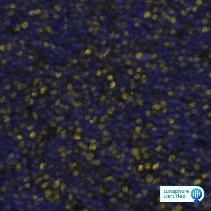 SOX11 was detected in immersion fixed paraffin-embedded sections of human Mantle Cell Lymphoma using Mouse Anti-Human SOX11, Monoclonal Antibody (Catalog # MAB11734) at 25ug/mL at 37° Celsius for 8 minutes. Before incubation with the primary antibody, tissue underwent an all-in-one dewaxing and antigen retrieval preprocessing using PreTreatment Module (PT Module) and Dewax and HIER Buffer H (pH 9; Epredia Catalog # TA-999-DHBH). Tissue was stained using the Alexa Fluor™ 647 Goat anti-Mouse IgG Secondary Antibody at 1:200 at 37 ° Celsius for 8 minutes. (Yellow; Lunaphore Catalog # DR647MS) and counterstained with DAPI (blue; Lunaphore Catalog # DR100).​ Specific staining was localized to the nucleus. Protocol available in COMET™ Panel Builder.