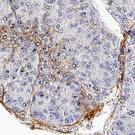 Collagen IV  alpha 1 was detected in immersion fixed paraffin-embedded sections of human liver cancer using Mouse Anti-Human Collagen IV  alpha 1 Monoclonal Antibody (Catalog # MAB11758) at 5 µg/ml overnight at 4 &deg;C. Before incubation with the primary antibody, tissue was subjected to heat-induced epitope retrieval using VisUCyte Antigen Retrieval Reagent-Basic (Catalog # VCTS021). Tissue was stained using the HRP-conjugated Anti-Mouse IgG Secondary Antibody (Catalog # HAF007) and counterstained with hematoxylin (blue). Specific staining was localized to the basement membrane. View our protocol for Chromogenic IHC Staining of Paraffin-embedded Tissue Sections.