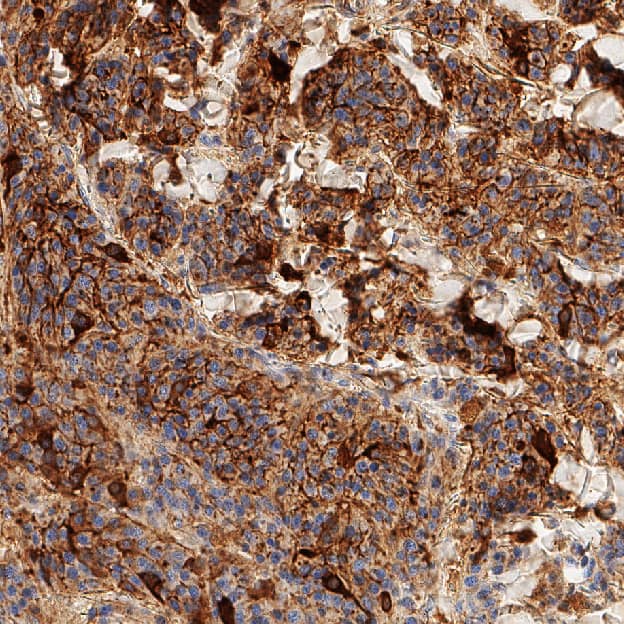 NG2/MCSP was detected in immersion fixed paraffin-embedded sections of human melanoma using Mouse Anti-Human NG2/MCSP Monoclonal Antibody (Catalog # MAB11767) at 5 µg/ml overnight at 4 &deg;C. Before incubation with the primary antibody, tissue was subjected to heat-induced epitope retrieval using VisUCyte Antigen Retrieval Reagent-Basic (VCTS021). Tissue was stained using the HRP-conjugated Anti-Mouse IgG Secondary Antibody (HAF007) and counterstained with hematoxylin (blue). Specific staining was localized to the cell membrane. View our protocol for Chromogenic IHC Staining of Paraffin-embedded Tissue Sections.