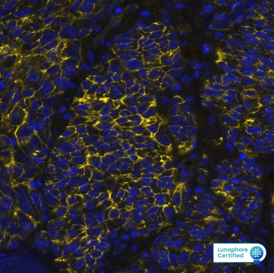 NG2/MCSP was detected in immersion fixed paraffin-embedded sections of human Melanoma using Mouse Anti-Human NG2/MCSP, Monoclonal Antibody (Catalog # MAB11767) at 15 μg/mL at 37° Celsius for 8 minutes. Before incubation with the primary antibody, tissue underwent an all-in-one dewaxing and antigen retrieval preprocessing using PreTreatment Module (PT Module) and Dewax and HIER Buffer H (pH 9; Epredia Catalog # TA-999-DHBH). Tissue was stained using the Alexa Fluor™ 647 Goat anti-Mouse IgG Secondary Antibody at 1:200 at 37° Celsius for 2 minutes. (Yellow; Lunaphore Catalog # DR647MS) and counterstained with DAPI (blue; Lunaphore Catalog # DR100). Specific staining was localized to the membrane. Protocol available in COMET™ Panel Builder.
