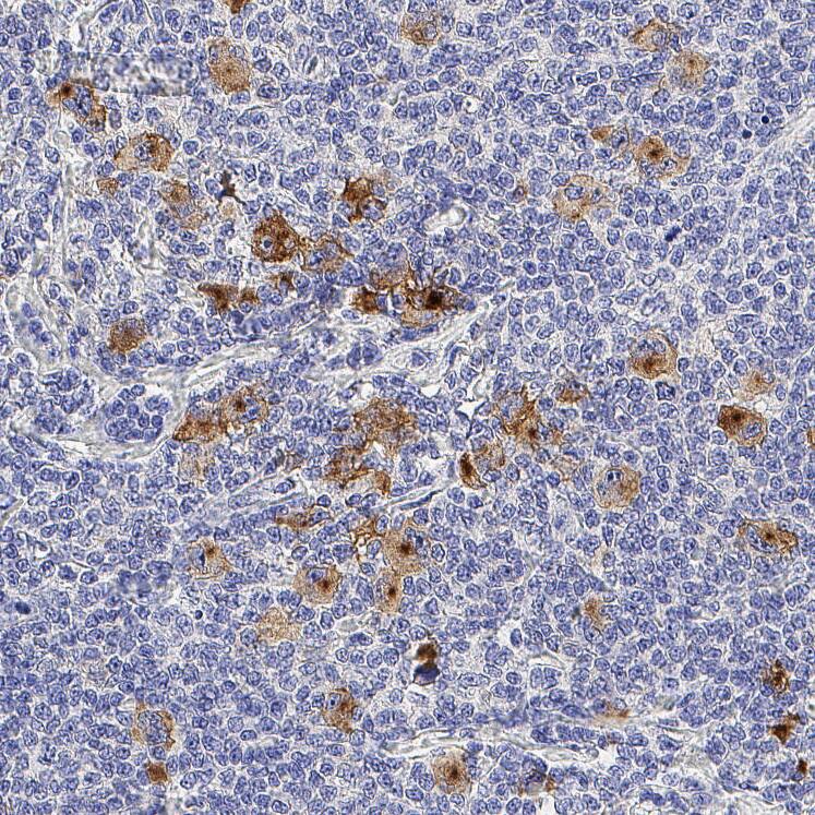 CD30/TNFRSF8 was detected in immersion fixed paraffin-embedded sections of human hodgkin's lymphoma using Mouse Anti-Human CD30/TNFRSF8 Monoclonal Antibody (Catalog # MAB11768) at 5 µg/ml overnight at 4 &deg;C. Before incubation with the primary antibody, tissue was subjected to heat-induced epitope retrieval using VisUCyte Antigen Retrieval Reagent-Basic (Catalog # VCTS021). Tissue was stained using the HRP-conjugated Anti-Mouse IgG Secondary Antibody (Catalog # HAF007) and counterstained with hematoxylin (blue). Specific staining was localized to the cell membrane of Reed Sternberg cells. View our protocol for Chromogenic IHC Staining of Paraffin-embedded Tissue Sections.