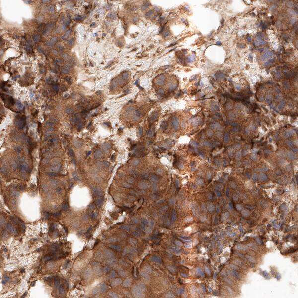VSP35 was detected in immersion fixed paraffin-embedded sections of human breast tumor using Mouse Anti-Human VSP35 Monoclonal Antibody (Catalog # MAB11770) at 5 µg/ml overnight at 4 &deg;C. Before incubation with the primary antibody, tissue was subjected to heat-induced epitope retrieval using VisUCyte Antigen Retrieval Reagent-Basic (VCTS021). Tissue was stained using the HRP-conjugated Anti-Mouse IgG Secondary Antibody (HAF007) and counterstained with hematoxylin (blue). Specific staining was localized to the cytoplasm and membrane in breast tumor. View our protocol for Chromogenic IHC Staining of Paraffin-embedded Tissue Sections.