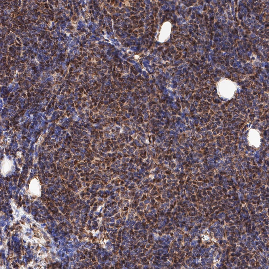 LMO2 was detected in immersion fixed paraffin-embedded sections of B-cell lymphoma using Mouse Anti-Human LMO2 Monoclonal Antibody (Catalog # MAB11790) at 0.25 µg/ml overnight at 4 &deg;C. Before incubation with the primary antibody, tissue was subjected to heat-induced epitope retrieval using VisUCyte Antigen Retrieval Reagent-Basic (VCTS021). Tissue was stained using the HRP-conjugated Anti-Mouse IgG Secondary Antibody (HAF007) and counterstained with hematoxylin (blue). Specific staining was localized to nuclei of the B-cell Lymphoma. View our protocol for Chromogenic IHC Staining of Paraffin-embedded Tissue Sections.
