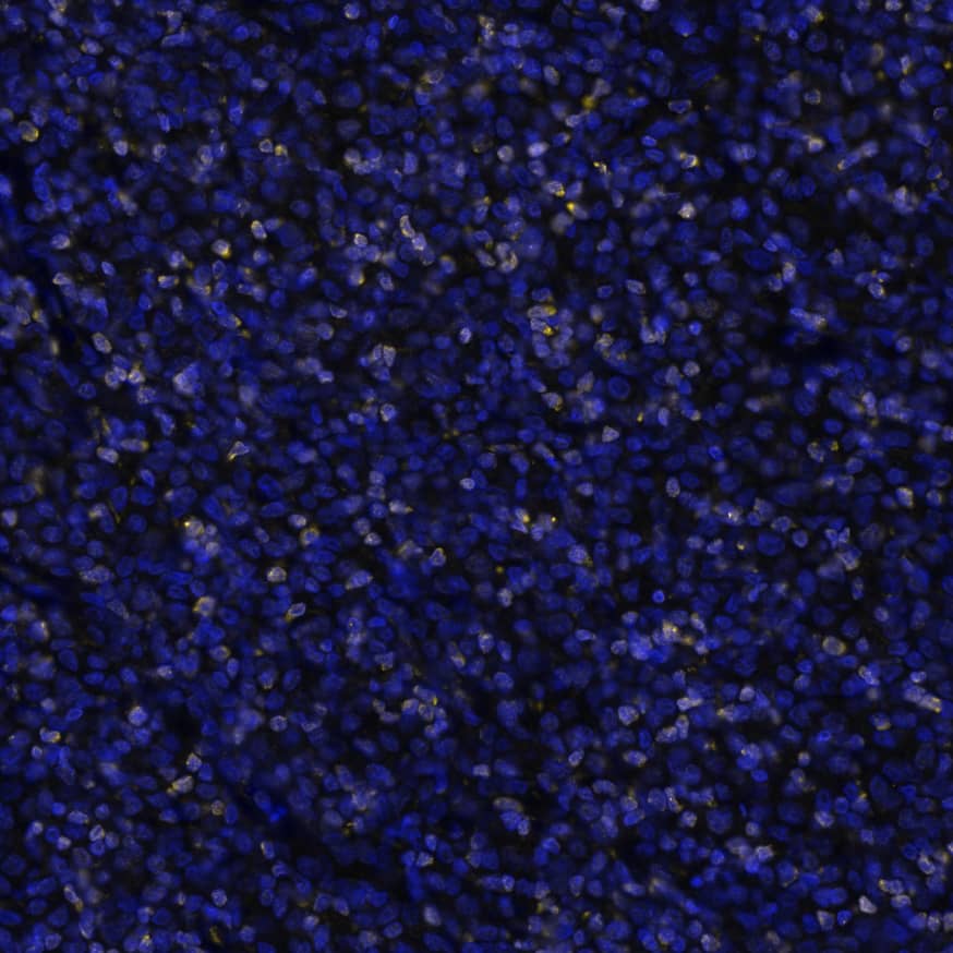 LMO2 was detected in immersion fixed paraffin-embedded sections of B-cell lymphoma using Mouse Anti-Human LMO2 Monoclonal Antibody (Catalog # MAB11790) at 0.3 µg/mL at 37 ° Celsius for 4 minutes. Before incubation with the primary antibody, tissue underwent an all-in-one dewaxing and antigen retrieval preprocessing using PreTreatment Module (PT Module) and Dewax and HIER Buffer H (pH 9; Epredia Catalog # TA-999-DHBH). Tissue was stained using the Alexa Fluor™ 647 Goat anti-Mouse IgG Secondary Antibody at 1:200 at 37 ° Celsius for 2 minutes. (Yellow; Lunaphore Catalog # DR647MS) and counterstained with DAPI (blue; Lunaphore Catalog # DR100). Specific staining was localized to the nucleus. Protocol available in COMET™ Panel Builder. ​