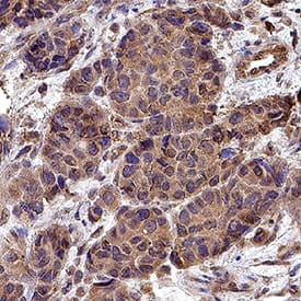 DLL1 was detected in immersion fixed paraffin-embedded sections of human breast cancer tissue using Mouse Anti-Human DLL1 Monoclonal Antibody (Catalog # MAB18181) at 1.7 &micro;g/mL for 1 hour at room temperature followed by incubation with the Anti-Mouse IgG VisUCyte&trade; HRP Polymer Antibody (VC001). Before incubation with the primary antibody, tissue was subjected to heat-induced epitope retrieval using Antigen Retrieval Reagent-Basic (CTS013). Tissue was stained using DAB (brown) and counterstained with hematoxylin (blue). Specific staining was localized to cytoplasm in cancer cells. Staining was performed using our protocol for IHC Staining with VisUCyte HRP Polymer Detection Reagents.