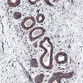 Akt was detected in immersion fixed paraffin-embedded sections of human breast cancer tissue using Mouse Anti-Human/Mouse/Rat Akt Pan Specific Monoclonal Antibody (Catalog # MAB2055) at 5 &micro;g/mL for 1 hour at room temperature followed by incubation with the Anti-Mouse IgG VisUCyte&trade; HRP Polymer Antibody (VC001). Before incubation with the primary antibody, tissue was subjected to heat-induced epitope retrieval using Antigen Retrieval Reagent-Basic (CTS013). Tissue was stained using DAB (brown) and counterstained with hematoxylin (blue). Specific staining was localized to cytoplasm in epithelial cells. Staining was performed using our IHC Staining with VisUCyte HRP Polymer Detection Reagents.