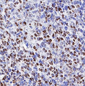 CHL‑1/L1CAM‑2 was detected in immersion fixed paraffin-embedded sections of human melanoma tissue using Rat Anti-Human CHL‑1/L1CAM‑2 Monoclonal Antibody (Catalog # MAB2126) at 1.7 µg/mL for 1 hour at room temperature followed by incubation with the Anti-Rat IgG VisUCyte™ HRP Polymer Antibody (VC005). Before incubation with the primary antibody, tissue was subjected to heat-induced epitope retrieval using Antigen Retrieval Reagent-Basic (CTS013). Tissue was stained using DAB (brown) and counterstained with hematoxylin (blue). Specific staining was localized to cell nuclei. Staining was performed using our protocol for IHC Staining with VisUCyte HRP Polymer Detection Reagents.