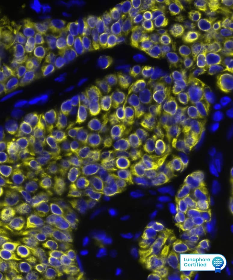 CXCL12/SDF-1 was detected in immersion fixed paraffin-embedded sections of human breast tumor using Mouse Anti-Human CXCL12/SDF-1, Monoclonal Antibody (Catalog #MAB350) at 15ug/mL at 37° Celsius for 4 minutes. Before incubation with the primary antibody, tissue underwent an all-in-one dewaxing and antigen retrieval preprocessing using PreTreatment Module (PT Module) and Dewax and HIER Buffer H (pH 9; Epredia Catalog # TA-999-DHBH). Tissue was stained using the Alexa Fluor™ 647 Goat anti-Mouse IgG Secondary Antibody at 1:200 at 37 ° Celsius for 2 minutes. (Yellow; Lunaphore Catalog # DR647MS) and counterstained with DAPI (blue; Lunaphore Catalog # DR100). Specific staining was localized to the cytoplasm. Protocol available in COMET™ Panel Builder.