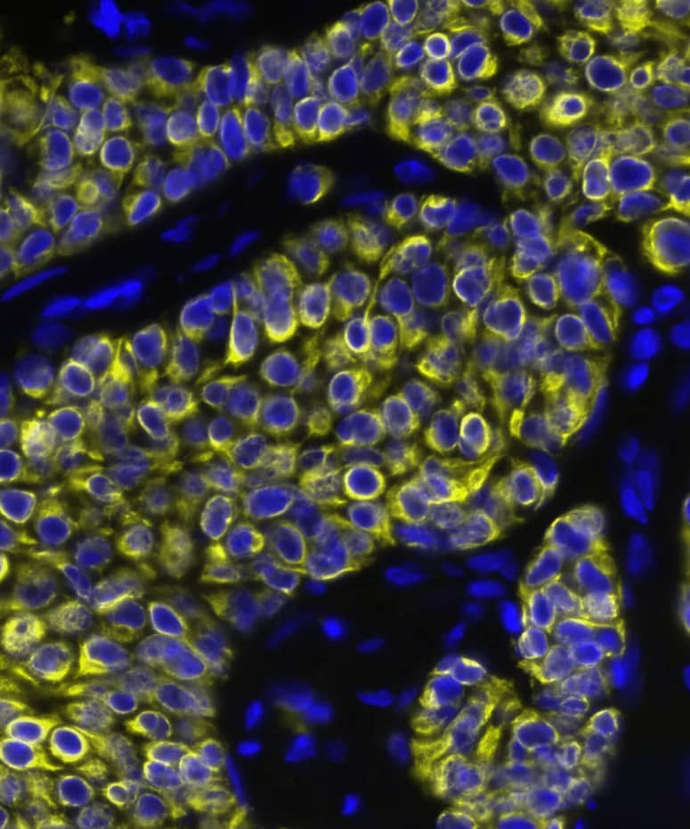CXCL12/SDF-1 was detected in immersion fixed paraffin-embedded sections of human breast tumor using Mouse Anti-Human CXCL12/SDF-1, Monoclonal Antibody (Catalog #MAB350) at 15ug/mL at 37° Celsius for 4 minutes. Before incubation with the primary antibody, tissue underwent an all-in-one dewaxing and antigen retrieval preprocessing using PreTreatment Module (PT Module) and Dewax and HIER Buffer H (pH 9; Epredia Catalog # TA-999-DHBH). Tissue was stained using the Alexa Fluor™ 647 Goat anti-Mouse IgG Secondary Antibody at 1:200 at 37 ° Celsius for 2 minutes. (Yellow; Lunaphore Catalog # DR647MS) and counterstained with DAPI (blue; Lunaphore Catalog # DR100). Specific staining was localized to the cytoplasm. Protocol available in COMET™ Panel Builder.