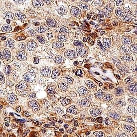 PAR1 was detected in immersion fixed paraffin-embedded sections of human breast cancer tissue using Mouse Anti-Human PAR1 Monoclonal Antibody (Catalog # MAB38551) at 5 µg/mL for 1 hour at room temperature followed by incubation with the Anti-Mouse IgG VisUCyte™ HRP Polymer Antibody (VC001). Before incubation with the primary antibody, tissue was subjected to heat-induced epitope retrieval using Antigen Retrieval Reagent-Basic (CTS013). Tissue was stained using DAB (brown) and counterstained with hematoxylin (blue). Specific staining was localized to cell membrane and cytoplasm in cancer cells. Staining was performed using our protocol for IHC Staining with VisUCyte HRP Polymer Detection Reagents.