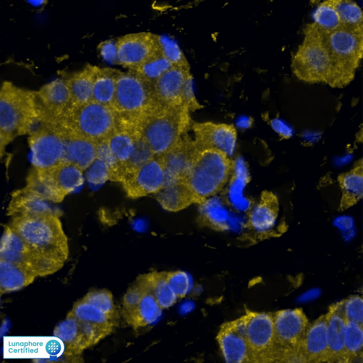 CXCR7 was detected in immersion fixed paraffin-embedded sections of human breast tumor using Mouse Anti-Human CXCR7 Monoclonal Antibody (Catalog # MAB4227) at 15ug/mL at 37 ° Celsius for 4 minutes. Before incubation with the primary antibody, tissue underwent an all-in-one dewaxing and antigen retrieval preprocessing using PreTreatment Module (PT Module) and Dewax and HIER Buffer H (pH 9). Tissue was stained using the Alexa Fluor™ 647 Goat anti-Mouse IgG Secondary Antibody at 1:200 at 37 ° Celsius for 2 minutes. (Yellow; Lunaphore Catalog # DR647MS) and counterstained with DAPI (blue; Lunaphore Catalog # DR100). Specific staining was localized to the cytoplasm. Protocol available in COMET™ Panel Builder.