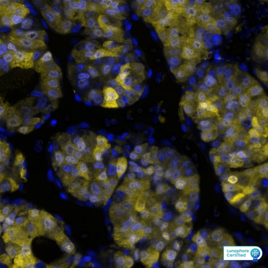 Arginase 1 was detected in immersion fixed paraffin-embedded sections of human Liver Tumor using Mouse Anti-Human Arginase 1, Monoclonal Antibody (Catalog # MAB5868) at 3ug/mL at 37° Celsius for 4 minutes. Before incubation with the primary antibody, tissue underwent an all-in-one dewaxing and antigen retrieval preprocessing using PreTreatment Module (PT Module) and Dewax and HIER Buffer H (pH 9; Epredia Catalog # TA-999-DHBH). Tissue was stained using the Alexa Fluor™ 647 Goat anti-Mouse IgG Secondary Antibody at 1:200 at 37 ° Celsius for 2 minutes. (Yellow; Lunaphore Catalog # DR647MS) and counterstained with DAPI (blue; Lunaphore Catalog # DR100). Specific staining was localized to the cytoplasm and nucleus. Protocol available in COMET™ Panel Builder.