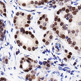 Androgen R/NR3C4 was detected in immersion fixed paraffin-embedded sections of human prostate cancer using Rabbit Anti-Human Androgen R/NR3C4 Monoclonal Antibody (Catalog # MAB58762) at 3 µg/mL for 1 hour at room temperature followed by incubation with the Anti-Rabbit IgG VisUCyte™ HRP Polymer Antibody (VC003). Before incubation with the primary antibody, tissue was subjected to heat-induced epitope retrieval using Antigen Retrieval Reagent-Basic (CTS013). Tissue was stained using DAB (brown) and counterstained with hematoxylin (blue). Specific staining was localized to cell nuclei. Staining was performed using our protocol for IHC Staining with VisUCyte HRP Polymer Detection Reagents.