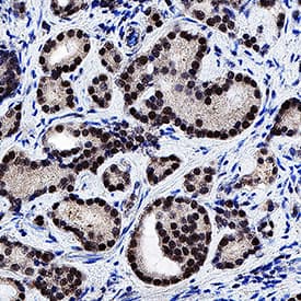 Androgen R/NR3C4 was detected in immersion fixed paraffin-embedded sections of human prostate cancer using Rabbit Anti-Human Androgen R/NR3C4 Monoclonal Antibody (Catalog # MAB58763) at 3 µg/mL for 1 hour at room temperature followed by incubation with the Anti-Rabbit IgG VisUCyte™ HRP Polymer Antibody (VC003). Before incubation with the primary antibody, tissue was subjected to heat-induced epitope retrieval using Antigen Retrieval Reagent-Basic (CTS013). Tissue was stained using DAB (brown) and counterstained with hematoxylin (blue). Specific staining was localized to cell nuclei. Staining was performed using our protocol for IHC Staining with VisUCyte HRP Polymer Detection Reagents.