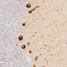 FGL2 was detected in immersion fixed paraffin-embedded sections of human cerebellum using Mouse Anti-Human FGL2 Monoclonal Antibody (Catalog # MAB5974) at 1 µg/ml for 1 hour at room temperature followed by incubation with the Anti-Mouse IgG VisUCyte™ HRP Polymer Antibody (Catalog # VC001). Before incubation with the primary antibody, tissue was subjected to heat-induced epitope retrieval using VisUCyte Antigen Retrieval Reagent-Basic (Catalog # VCTS021). Tissue was stained using DAB (brown) and counterstained with hematoxylin (blue). Specific staining was localized to the cytoplasm of Purkinje Neurons. View our protocol for IHC Staining with VisUCyte HRP Polymer Detection Reagents.