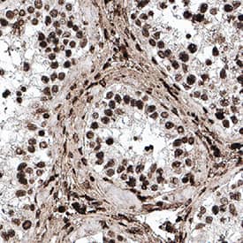 Bromodeoxyuridine/BrdU was detected in immersion fixed paraffin-embedded sections of human breast cancer tissue using Mouse Anti-Bromodeoxyuridine/BrdU Monoclonal Antibody (Catalog # MAB7225) at 1 &micro;g/mL for 1 hour at room temperature followed by incubation with the Anti-Mouse IgG VisUCyte&trade; HRP Polymer Antibody (VC001). Before incubation with the primary antibody, tissue was subjected to heat-induced epitope retrieval using Antigen Retrieval Reagent-Basic (CTS013). Tissue was stained using DAB (brown) and counterstained with hematoxylin (blue). Specific staining was localized to cell nuclei. Staining was performed using our protocol for IHC Staining with VisUCyte HRP Polymer Detection Reagents.