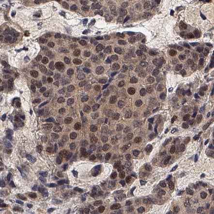 SOX6 was detected in immersion fixed paraffin-embedded sections of Human Liver Cancer using Mouse Anti-Human SOX6 Monoclonal Antibody (Catalog # MAB77591) at 5 µg/mL for 1 hour at room temperature followed by incubation with the Anti-Mouse IgG VisUCyte™ HRP Polymer Antibody (Catalog # VC001). Before incubation with the primary antibody, tissue was subjected to heat-induced epitope retrieval using VisUCyte Antigen Retrieval Reagent-Basic (Catalog # VCTS021). Tissue was stained using DAB (brown) and counterstained with hematoxylin (blue). Specific staining was localized to cell nuclei. View our protocol for IHC Staining with VisUCyte HRP Polymer Detection Reagents.