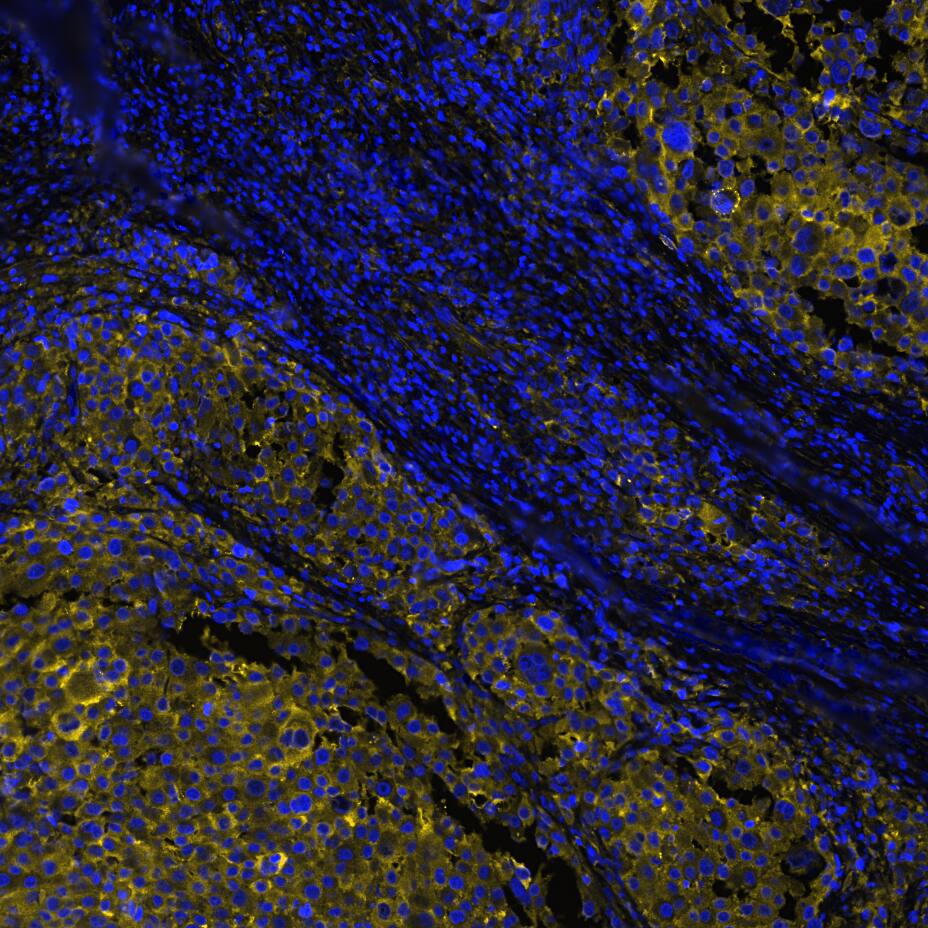 MART-1 was detected in immersion fixed paraffin-embedded sections of human melanoma using Mouse Anti-Human MART-1, Monoclonal Antibody (Catalog #MAB8008) at 25ug/mL at 37° Celsius for 4 minutes. Before incubation with the primary antibody, tissue underwent an all-in-one dewaxing and antigen retrieval preprocessing using PreTreatment Module (PT Module)and Dewax and HIER Buffer H (pH 9; Epredia Catalog #TA-999-DHBH). Tissue was stained using the Alexa Fluor™ 647 Goat anti-Mouse IgG Secondary Antibody at 1:200 at 37 ° Celsius for 2 minutes. (Yellow; Lunaphore Catalog # DR647MS) and counterstained with DAPI (blue; Lunaphore Catalog # DR100). Specific staining was localized to the cytoplasm. Protocol available in COMET™ Panel Builder.