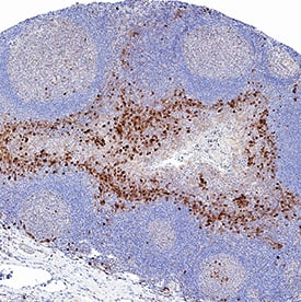 IL‑6 was detected in immersion fixed paraffin-embedded sections of human tonsil using Rabbit Anti-Human IL‑6 Monoclonal Antibody (Catalog # MAB95402) at 3 µg/mL for 1 hour at room temperature followed by incubation with the Anti-Rabbit IgG VisUCyte™ HRP Polymer Antibody (VC003). Before incubation with the primary antibody, tissue was subjected to heat-induced epitope retrieval using Antigen Retrieval Reagent-Basic (CTS013). Tissue was stained using DAB (brown) and counterstained with hematoxylin (blue).  Specific staining was localized to lymphocytes. Staining was performed using our protocol for IHC Staining with VisUCyte HRP Polymer Detection Reagents.