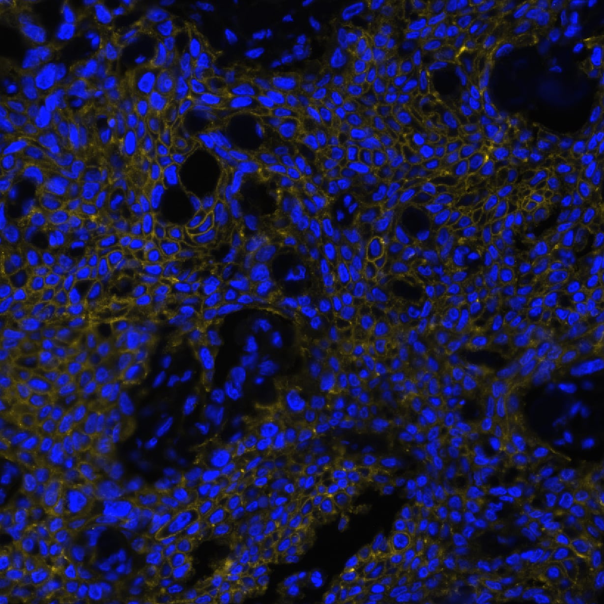 EMMPRIN/CD147 was detected in immersion fixed paraffin-embedded sections of human pancreatic cancer using Mouse Anti-Human EMMPRIN/CD147 Monoclonal Antibody (Catalog # MAB9721) at 1 µg/mL at 37 ° Celsius for 4 minutes. Before incubation with the primary antibody, tissue underwent an all-in-one dewaxing and antigen retrieval preprocessing using PreTreatment Module (PT Module) and Dewax and HIER Buffer H (pH 9; Epredia Catalog # TA-999-DHBH). Tissue was stained using the Alexa Fluor™ 647 Goat anti-Mouse IgG Secondary Antibody at 1:200 at 37 ° Celsius for 2 minutes. (Yellow; Lunaphore Catalog # DR647MS) and counterstained with DAPI (blue; Lunaphore Catalog # DR100). Specific staining was localized to the membrane. Protocol available in COMET™ Panel Builder.