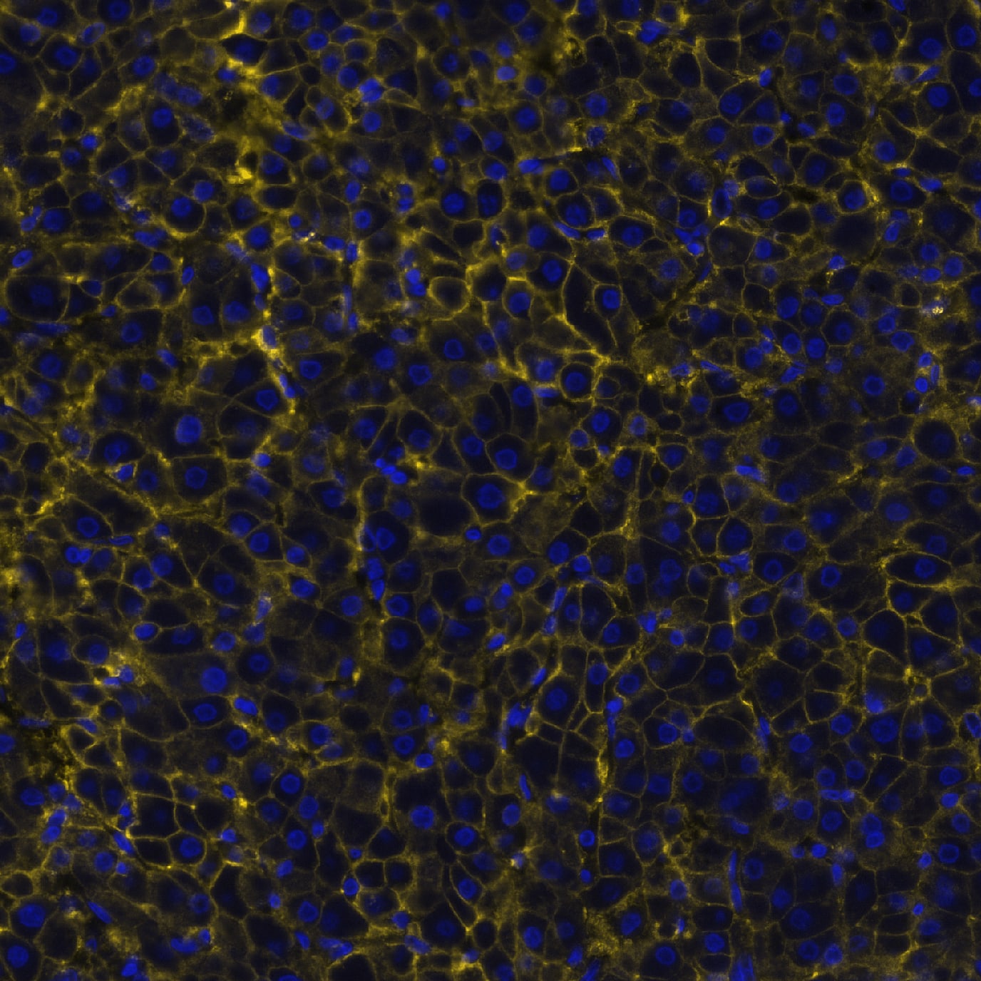 EMMPRIN/CD147 was detected in immersion fixed paraffin-embedded sections of human liver cancer using Mouse Anti-Human EMMPRIN/CD147 Monoclonal Antibody (Catalog # MAB9721) at 1 µg/mL at 37 ° Celsius for 4 minutes. Before incubation with the primary antibody, tissue underwent an all-in-one dewaxing and antigen retrieval preprocessing using PreTreatment Module (PT Module) and Dewax and HIER Buffer H (pH 9; Epredia Catalog # TA-999-DHBH). Tissue was stained using the Alexa Fluor™ 647 Goat anti-Mouse IgG Secondary Antibody at 1:200 at 37 ° Celsius for 2 minutes. (Yellow; Lunaphore Catalog # DR647MS) and counterstained with DAPI (blue; Lunaphore Catalog # DR100). Specific staining was localized to the membrane. Protocol available in COMET™ Panel Builder.