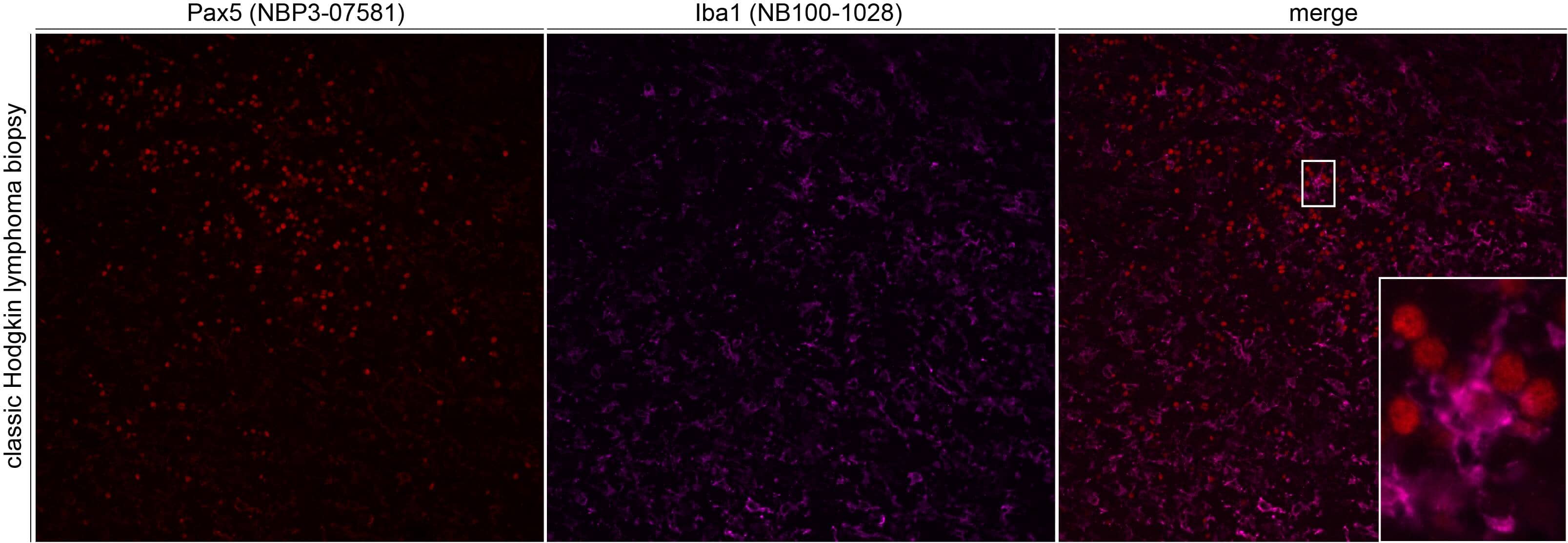 Immunohistochemistry: Goat Polyclonal AIF-1/Iba1 Antibody [NB100-1028] - Pax5 and Iba1 immunoreactivity in a formalin fixed paraffin embedded classic Hodgkin's lymphoma biopsy. Formalin fixed paraffin embedded sections were deparaffinized and rehydrated. Sections then underwent heat induced epitope retrieval in a citrate-based solution for 20min in a food steamer. Sections were cooled, then blocked in phosphate buffered saline containing 0.2% Triton-X100 and 10% normal donkey serum for 1h at room temperature. Sections were then incubated with the primary antibody for 16h at room temperature. The following day slides were washed three times with PBS containing 0.05% Tween-20. Sections were then incubated with donkey anti-goat (647 conjugate) at 5ug per mL for 45min at room temperature. Slides were then washed as above and mounted with a coverslip. Image from a verified customer review.