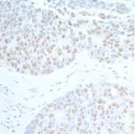 Section of human breast carcinoma.Antibody: Affinity purified rabbit anti- SUPT6H  used at a dilution of 1:200 (1µg/ml).Detection: DAB