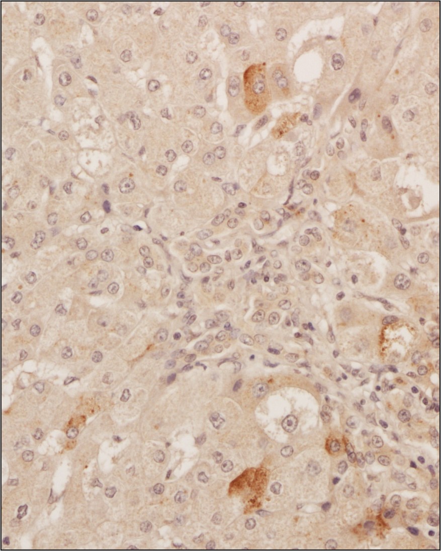 Analysis of a FFPE tissue section of human liver using 1:200 dilution of VEGF antibody [VG1]. The staining was developed using HRP labeled anti-rabbit secondary antibody and DAB reagent, and nuclei of cells were counter-stained with hematoxylin.