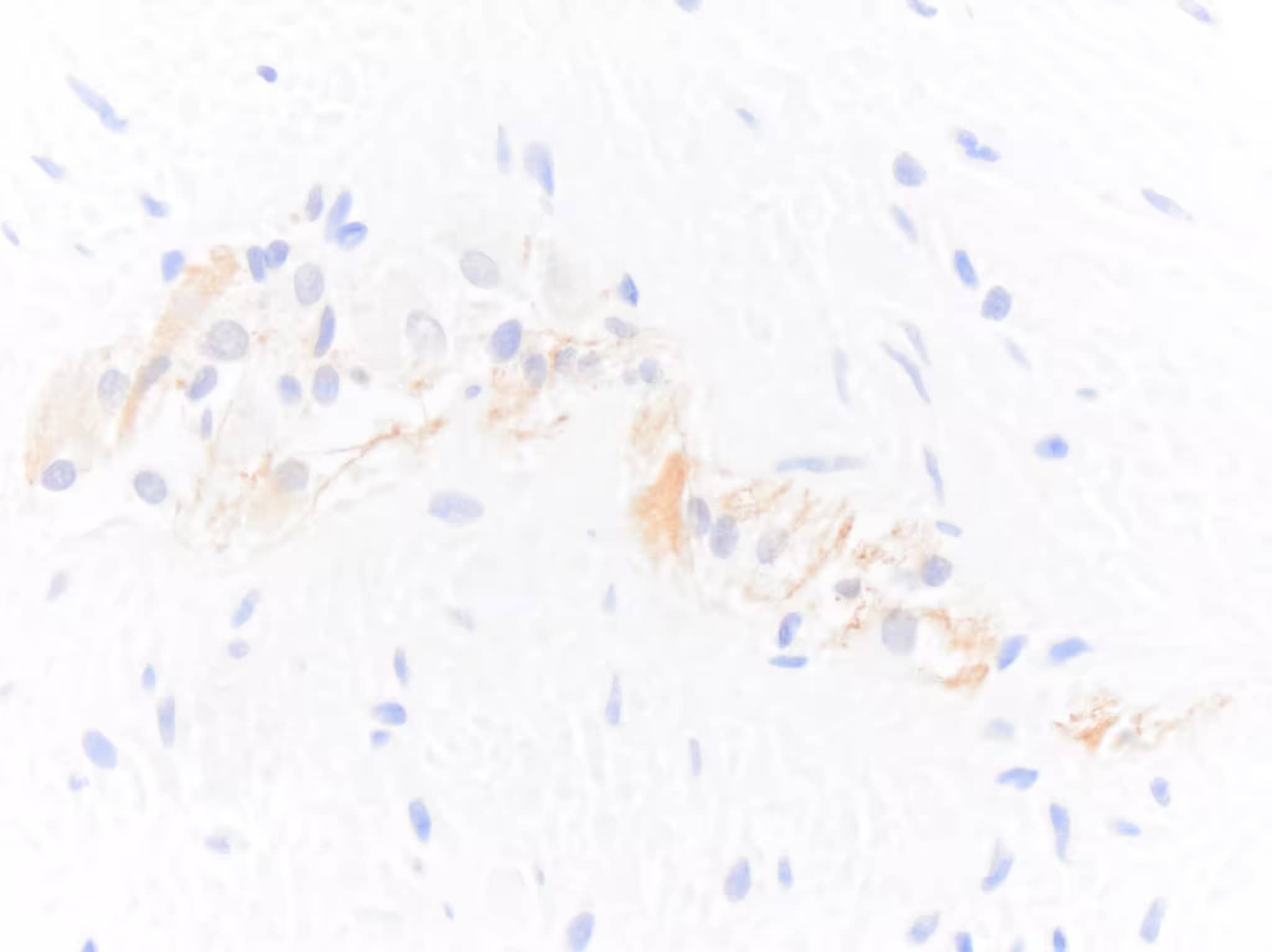 Immunohistochemistry-Paraffin: Chicken Polyclonal NF-H Antibody [NB300-217] - FFPE section of human colon showing NF-H NB300-217 immunoreactivity in enteric neurons. Primary antibody was diluted 1 in 2000 and left on tissue sections for 30m at room temperature. Secondary was donkey anti chicken HRP. Image from a verified customer review.